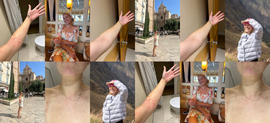 Lucy's eczema transformation with every&one multi-tasking cream